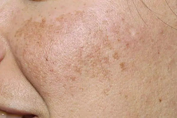 پوست دارای لک ملاسما