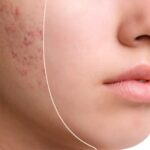 4 کرم ضد لک و روشن کننده فاقد هیدروکینون